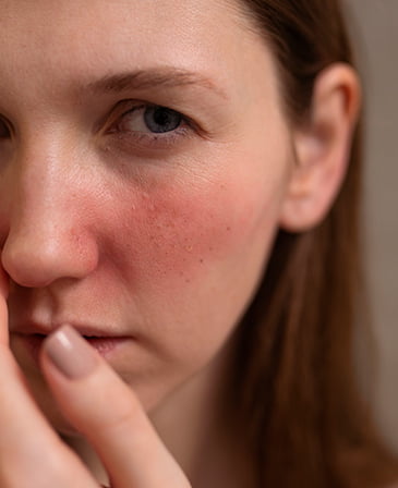 Rosacea