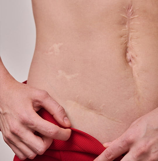 Stretch Marks & Scars